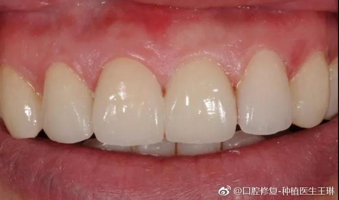 赛德阳光口腔 王琳医生 超薄贴面不磨牙 牙齿修复美容 赛德阳光口腔 王琳医生 超薄贴面不磨牙 牙齿修复美容