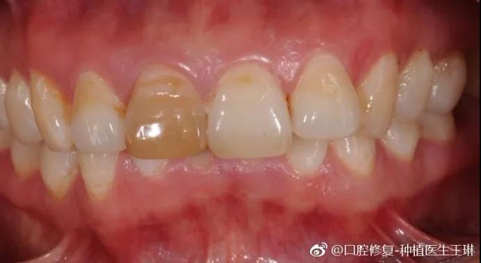 赛德阳光口腔 王琳医生 超薄贴面不磨牙 牙齿修复美容 赛德阳光口腔 王琳医生 超薄贴面不磨牙 牙齿修复美容