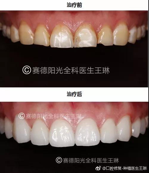 赛德阳光口腔 王琳医生 超薄贴面不磨牙 牙齿修复美容 赛德阳光口腔 王琳医生 超薄贴面不磨牙 牙齿修复美容