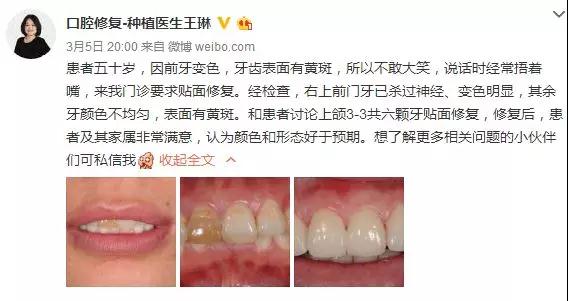 赛德阳光口腔 王琳医生 超薄贴面不磨牙 牙齿修复美容 赛德阳光口腔 王琳医生 超薄贴面不磨牙 牙齿修复美容