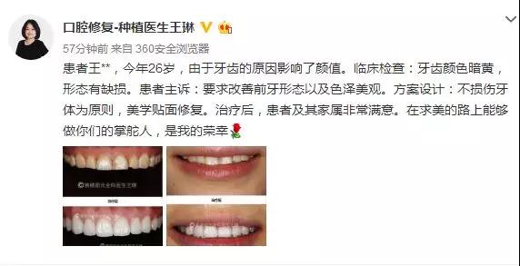 赛德阳光口腔 王琳医生 超薄贴面不磨牙 牙齿修复美容 赛德阳光口腔 王琳医生 超薄贴面不磨牙 牙齿修复美容
