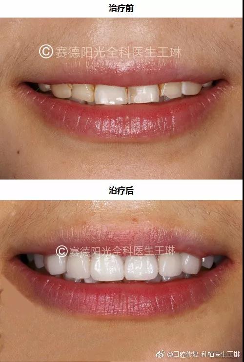 赛德阳光口腔 王琳医生 超薄贴面不磨牙 牙齿修复美容 赛德阳光口腔 王琳医生 超薄贴面不磨牙 牙齿修复美容