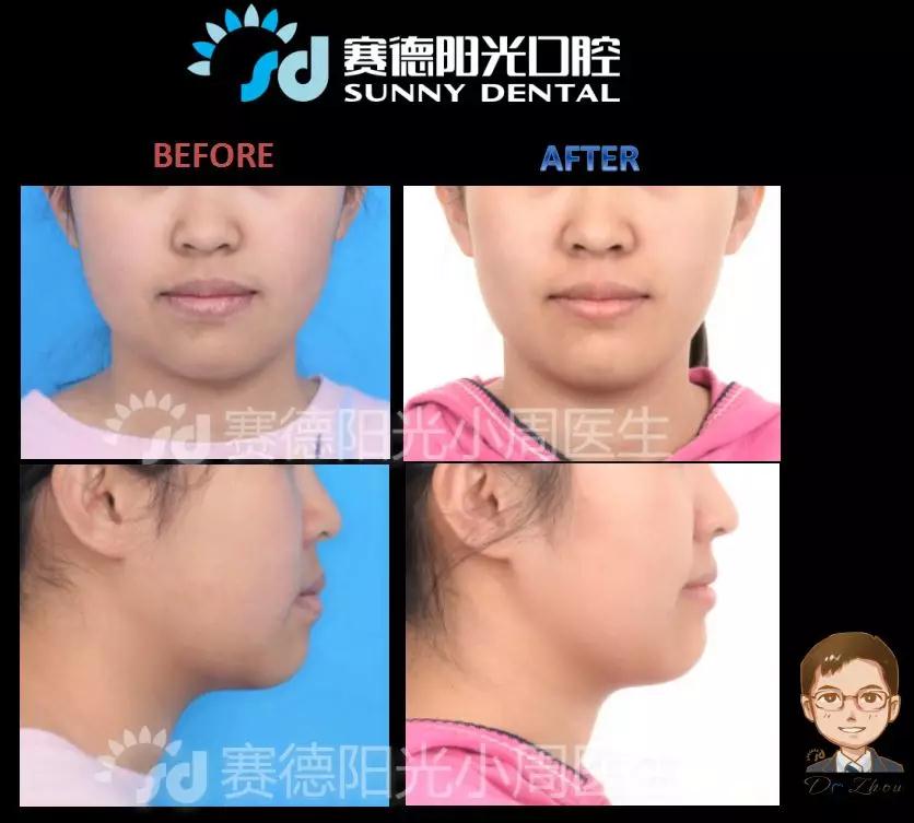 赛德阳光口腔周绍楠医生正畸案例前后对比图 赛德阳光口腔周绍楠医生正畸案例前后对比图