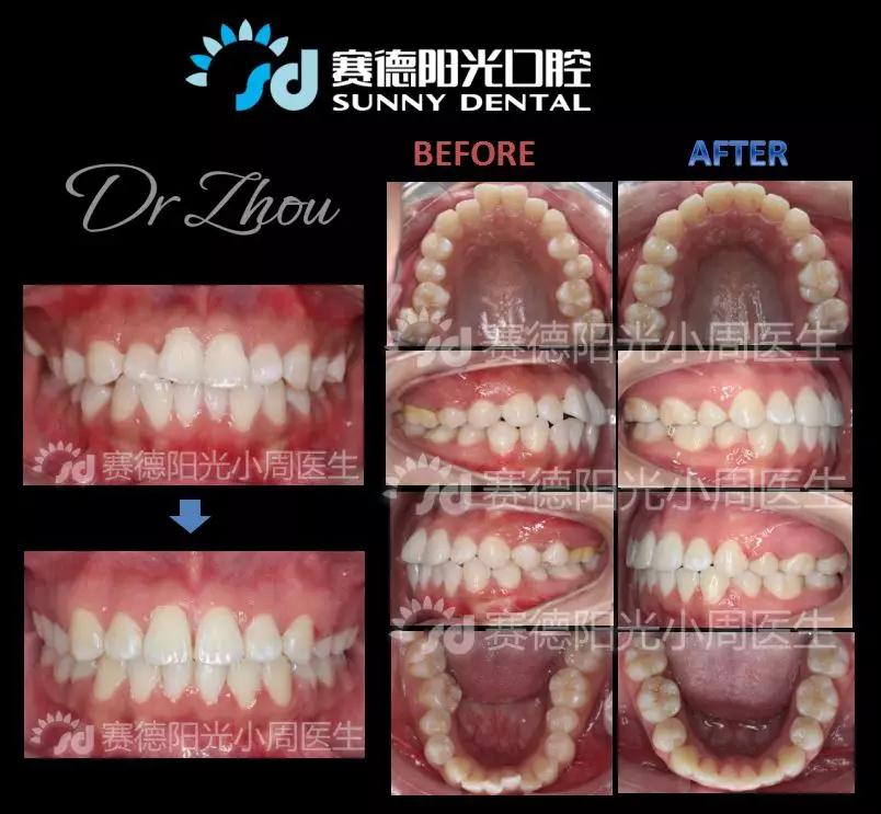 赛德阳光口腔周绍楠医生正畸案例前后对比图 赛德阳光口腔周绍楠医生正畸案例前后对比图