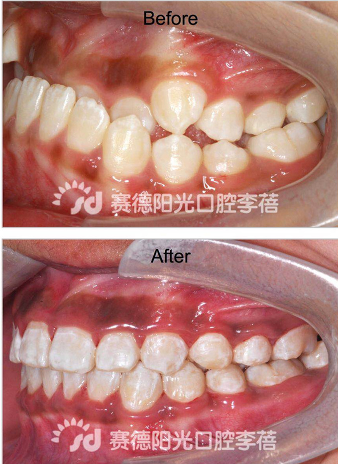 赛德阳光口腔 李蓓 正畸解决地包天 前后对比图