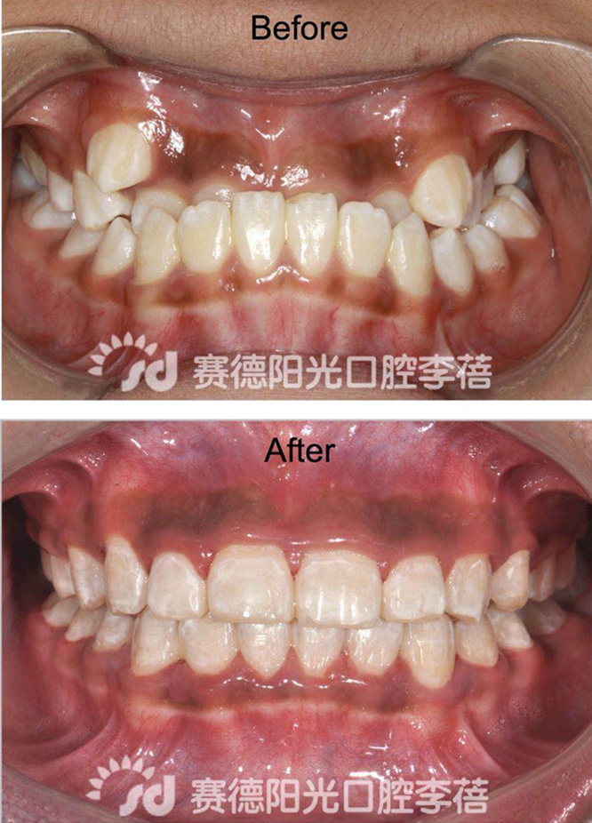 赛德阳光口腔 李蓓 正畸解决地包天 前后对比图