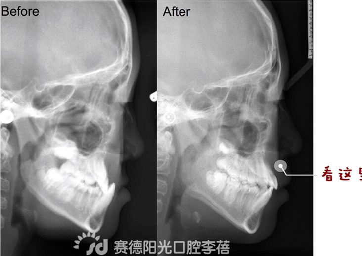 赛德阳光口腔 李蓓 正畸解决地包天 前后对比图