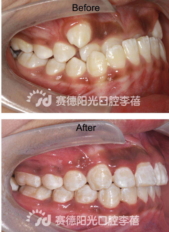 赛德阳光口腔 李蓓 正畸解决地包天 前后对比图
