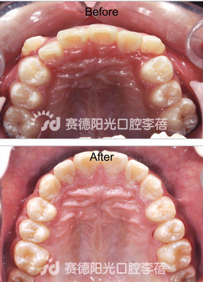 赛德阳光口腔 李蓓 正畸解决地包天 前后对比图