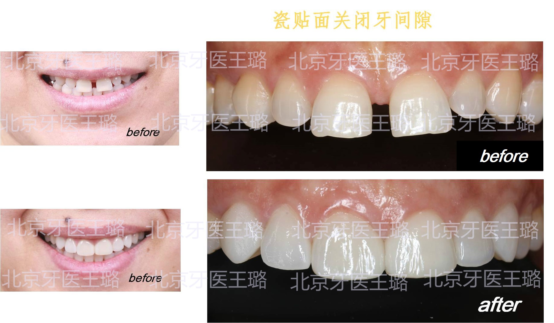 瓷贴面关闭牙间隙案例。【赛德阳光口腔王璐】