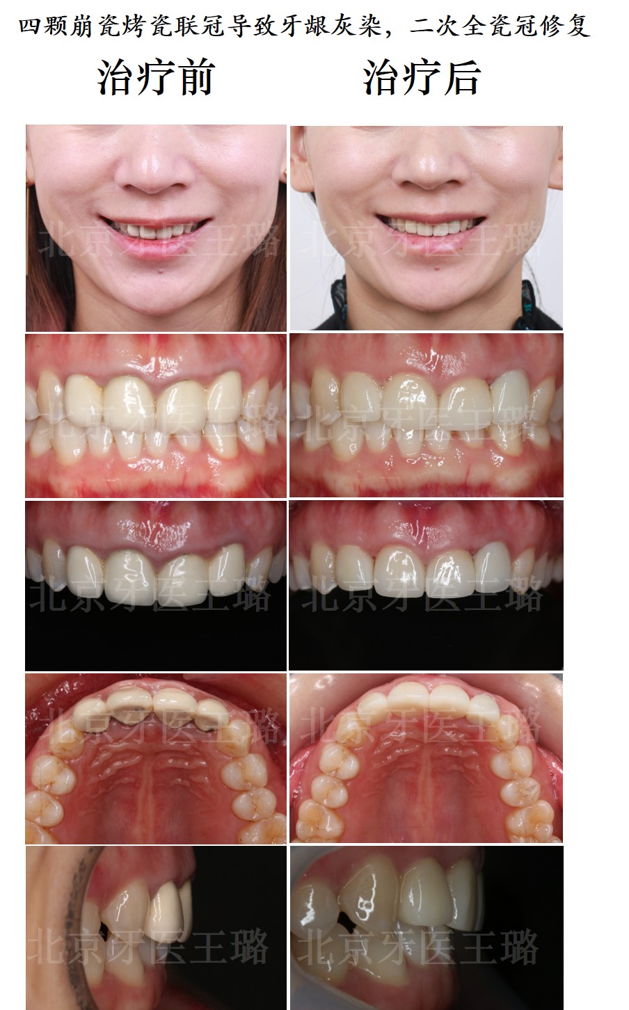四颗崩瓷烤瓷联冠导致牙龈灰染，二次全瓷冠修复。【赛德阳光口腔王璐】