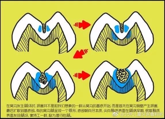 儿牙专家鲁莉英解读窝沟封闭和涂氟 赛德阳光口腔 北大口腔