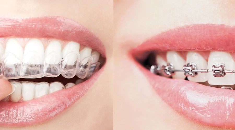 【对号入座】你更适合哪种正畸牙套？