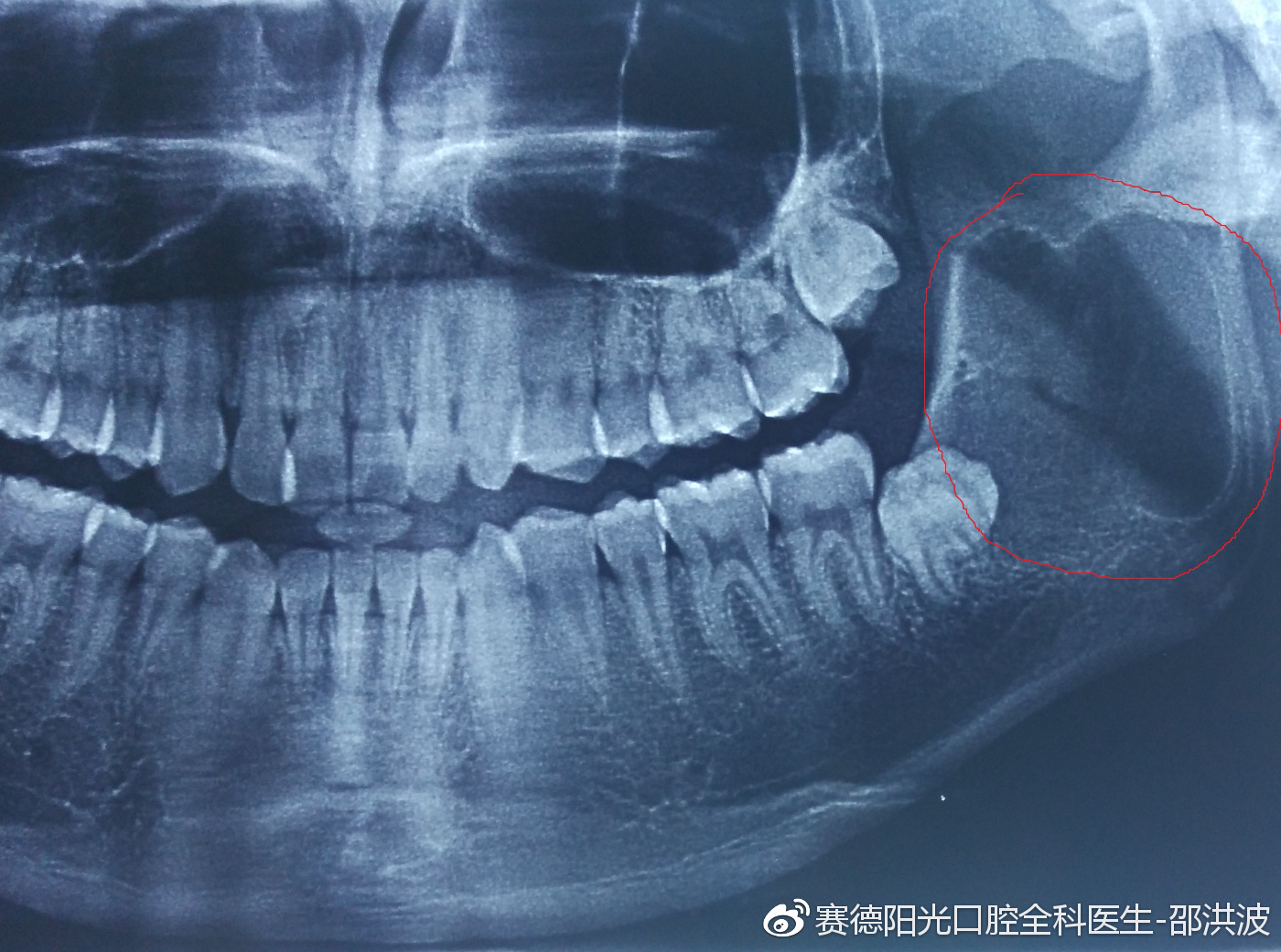 智齿的危害_外科拔牙_苏州口腔医院