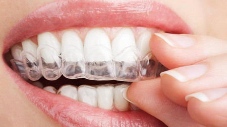 隐适美矫正期间，如何让牙齿高效移动？