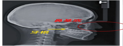 牙齿矫正和鼻基底，有关系么？