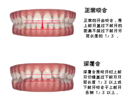 深覆合