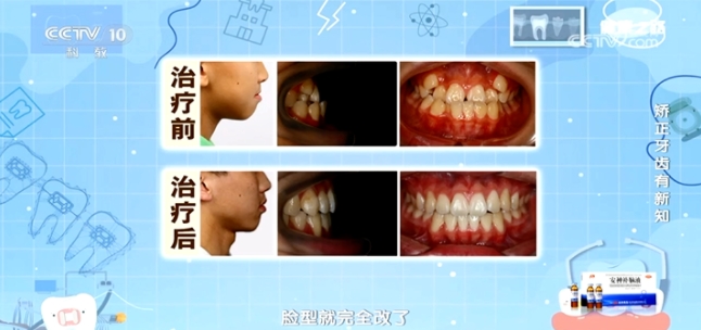 知名口腔正畸专家、北京清华长庚医院口腔医学中心主任、赛德阳光口腔创始人周彦恒教授展示一例11岁男孩地包天嘴突牙齿矫正案例前后对比图