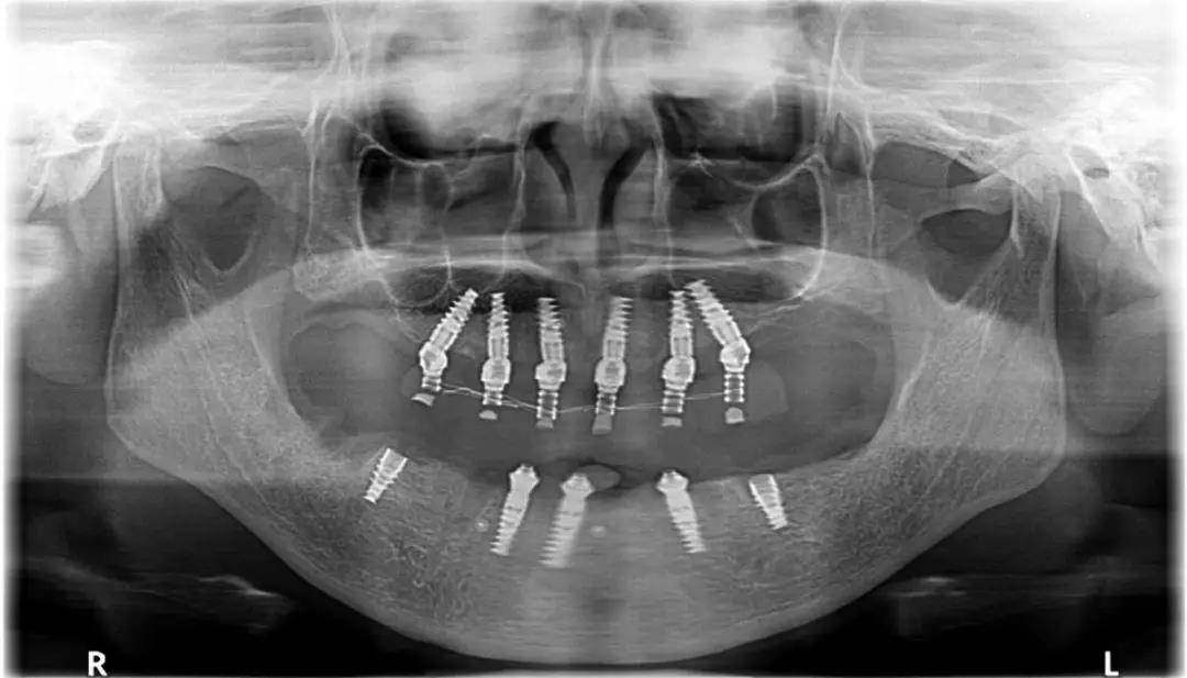 64岁患者分享自己种植修复牙齿的经历~