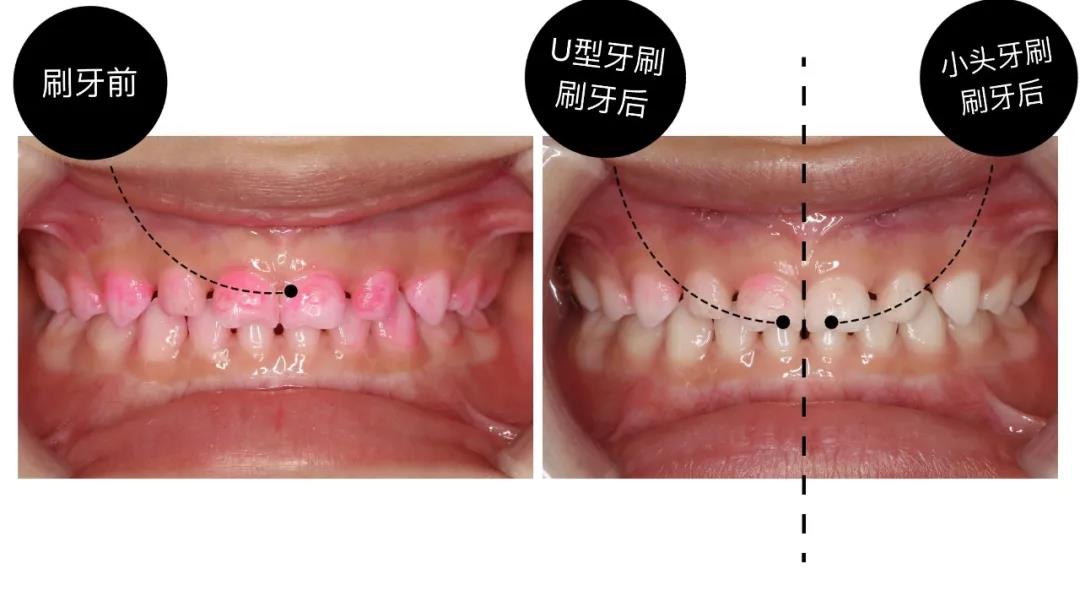 儿童小头牙刷 PK “网红”U型牙刷 