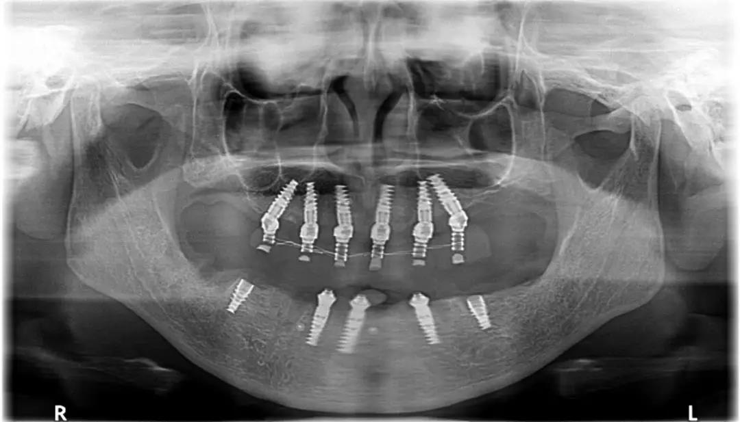 上下颌植体全部植入后