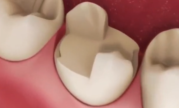 全瓷嵌体修复适用人群及大面积牙体缺损修复案