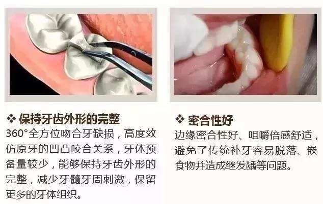 边缘密合性高。这一点取决于专业牙医的操作技术和口腔技师的制作水平