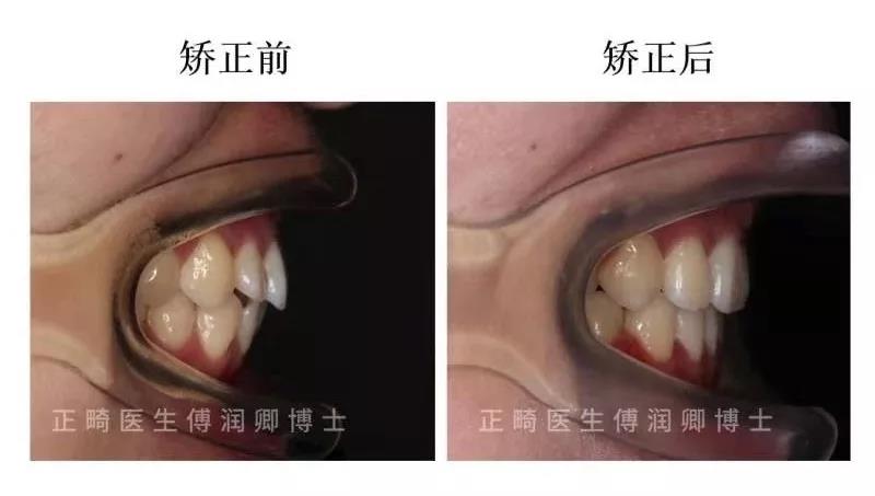 牙齿矫正效果怎么样？看看你能做到吗？