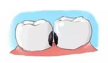 为什么容易有龋齿？——种植牙医高恩峰