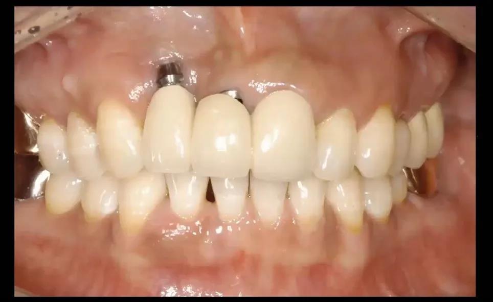 上颌种植牙与下颌自然牙不停的撞击导致唇侧的牙槽骨吸收，牙龈退缩，于是种植体露出来了。