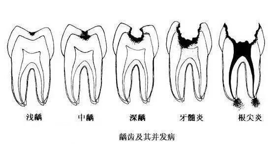 判定口腔健康的其中一个重要标准就是自然牙的健康状况