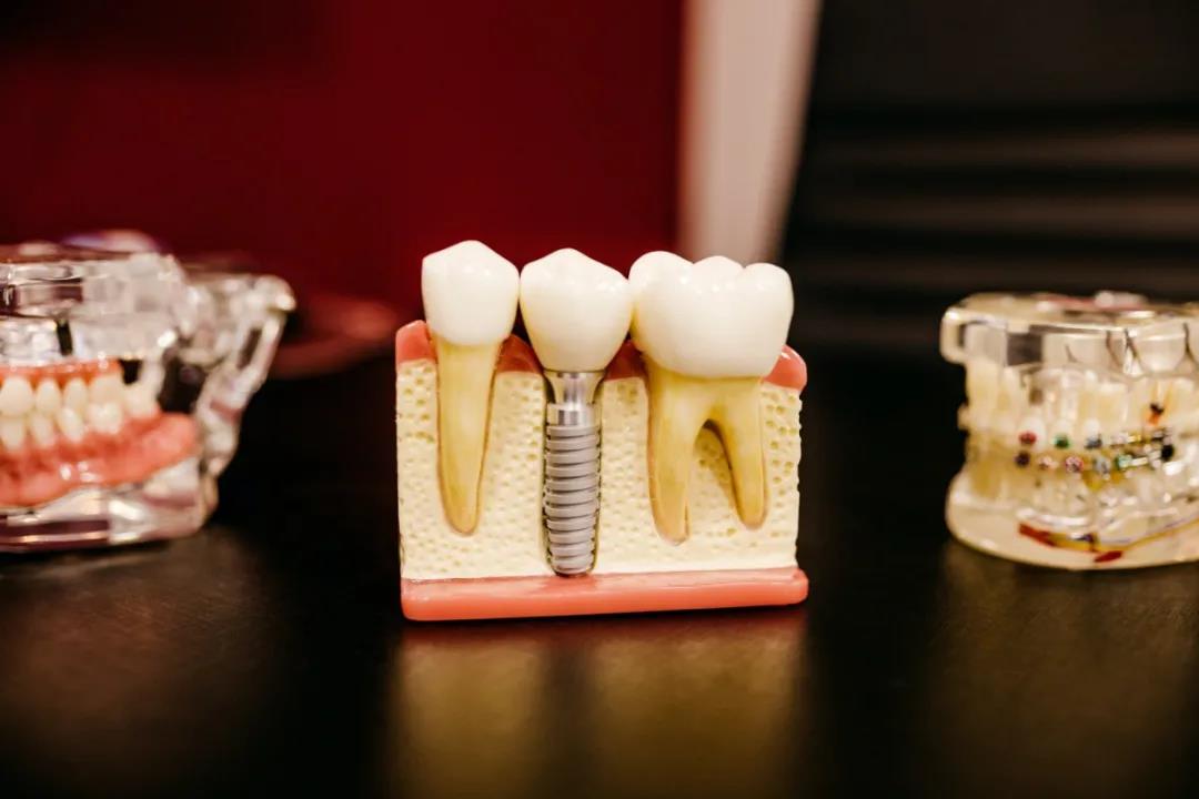 牙齿种植 | 松动的牙齿能否保留？